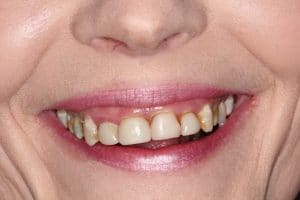 GWBefore before laser gum treatment