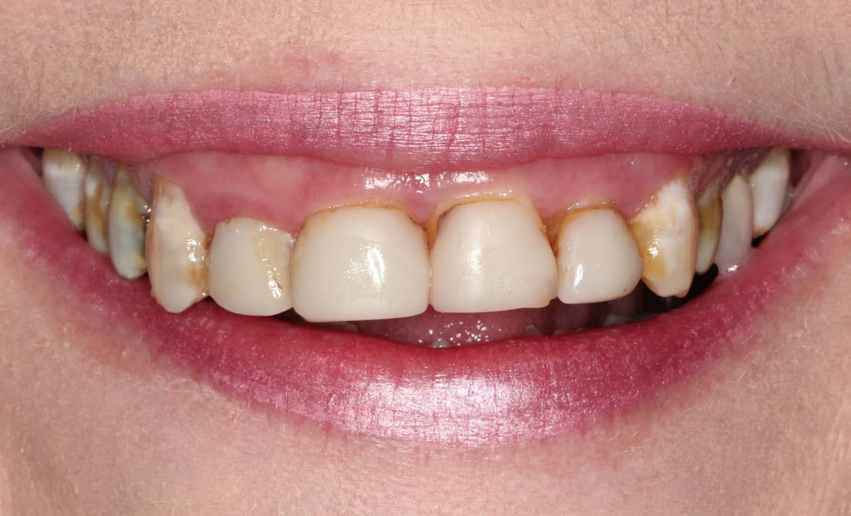 Before Treatment