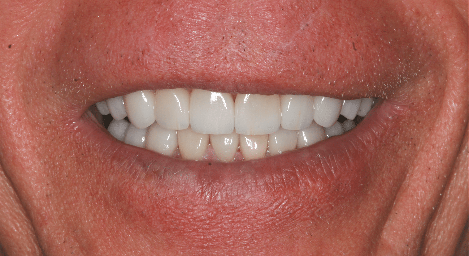 Porcelain Veneers Patient