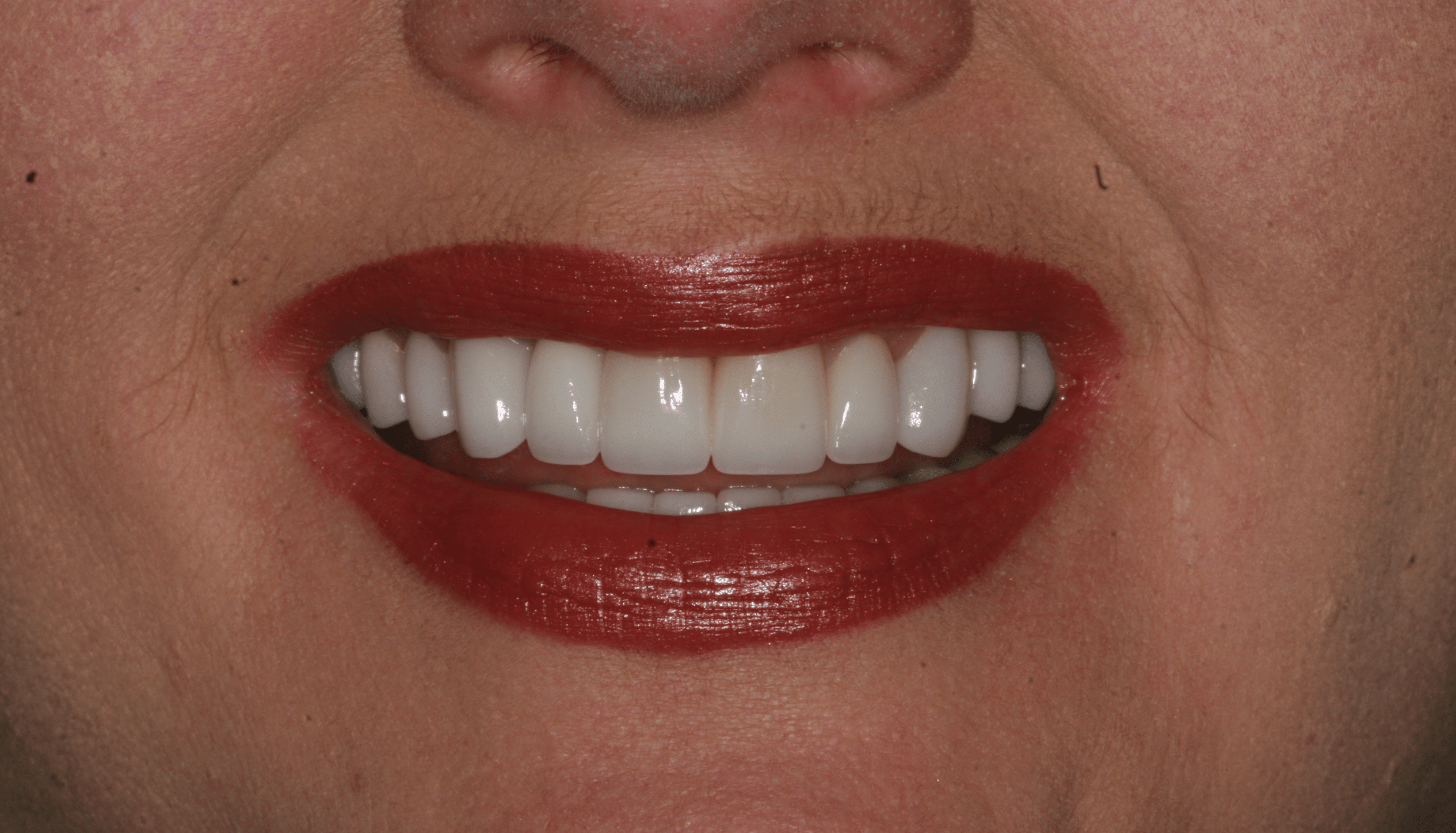 Dental Implant Patient 3