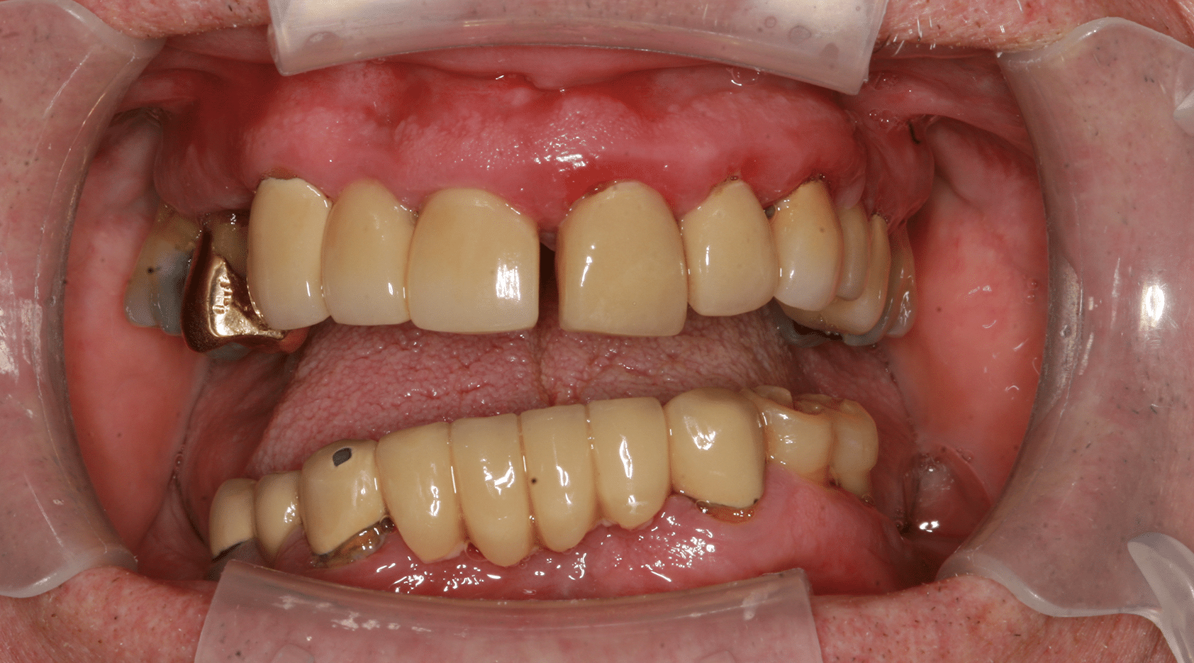 Dental Implants Patient 5