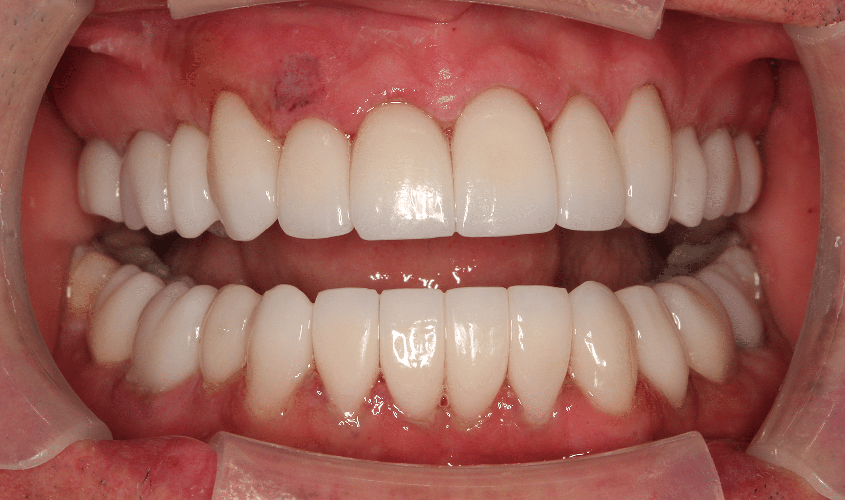 Full Mouth Rejuvenation 1