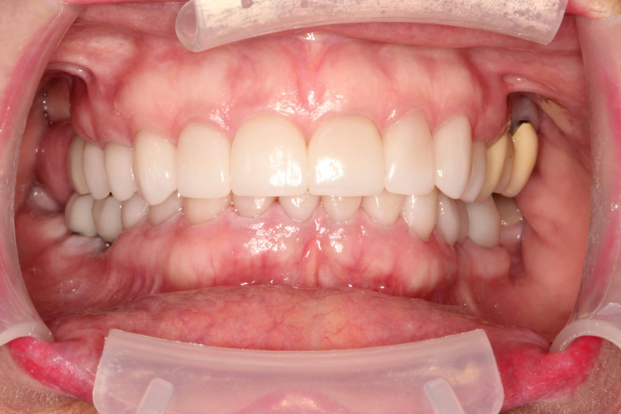 After Treatment