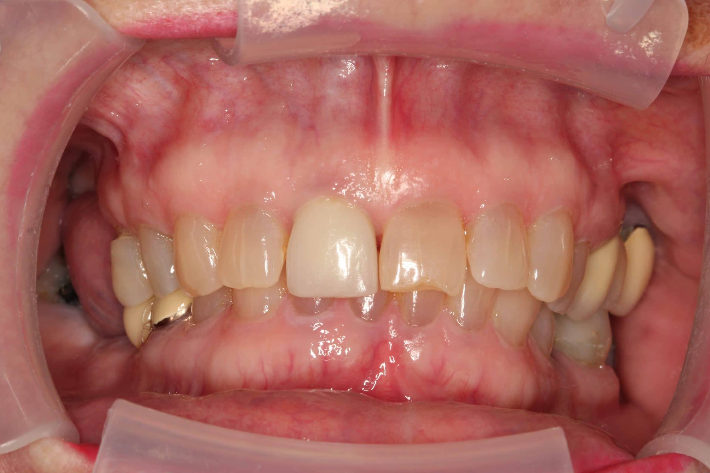 Before Treatment