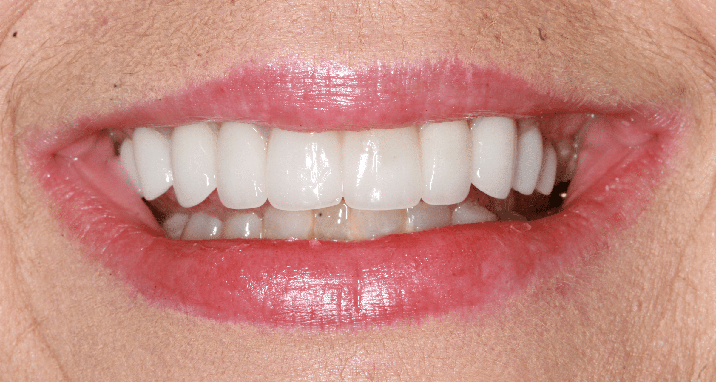 Porcelain Veneers Patient 2