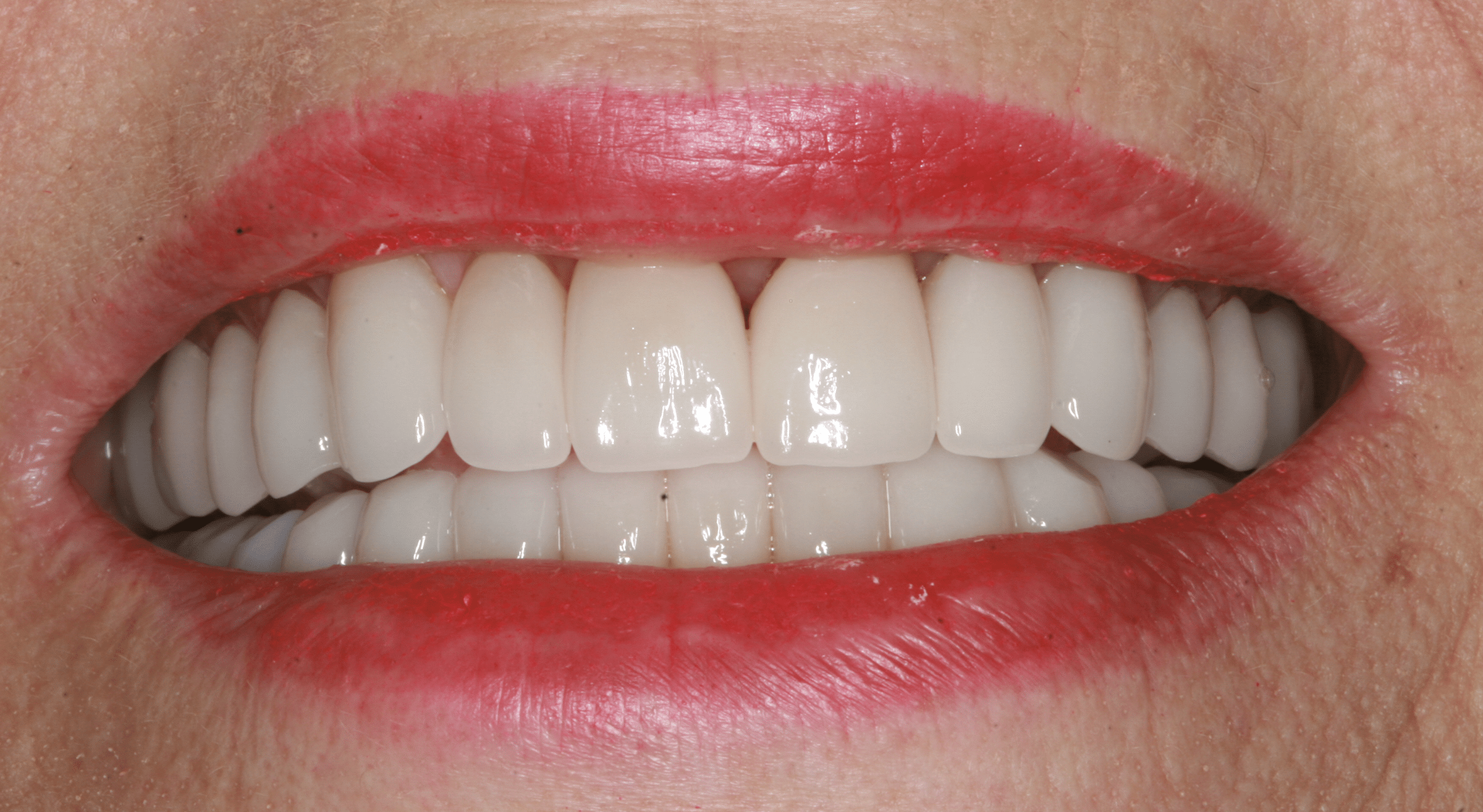 Porcelain Veneers Patient 3