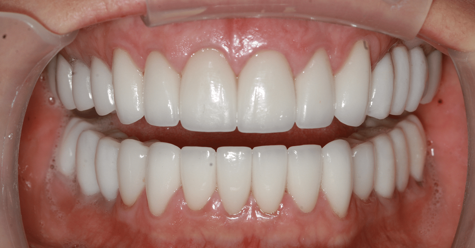 Porcelain Veneers Patient