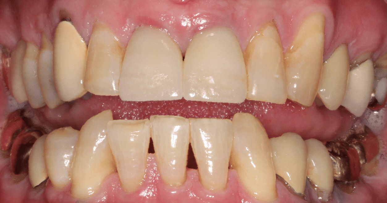 Before Treatment