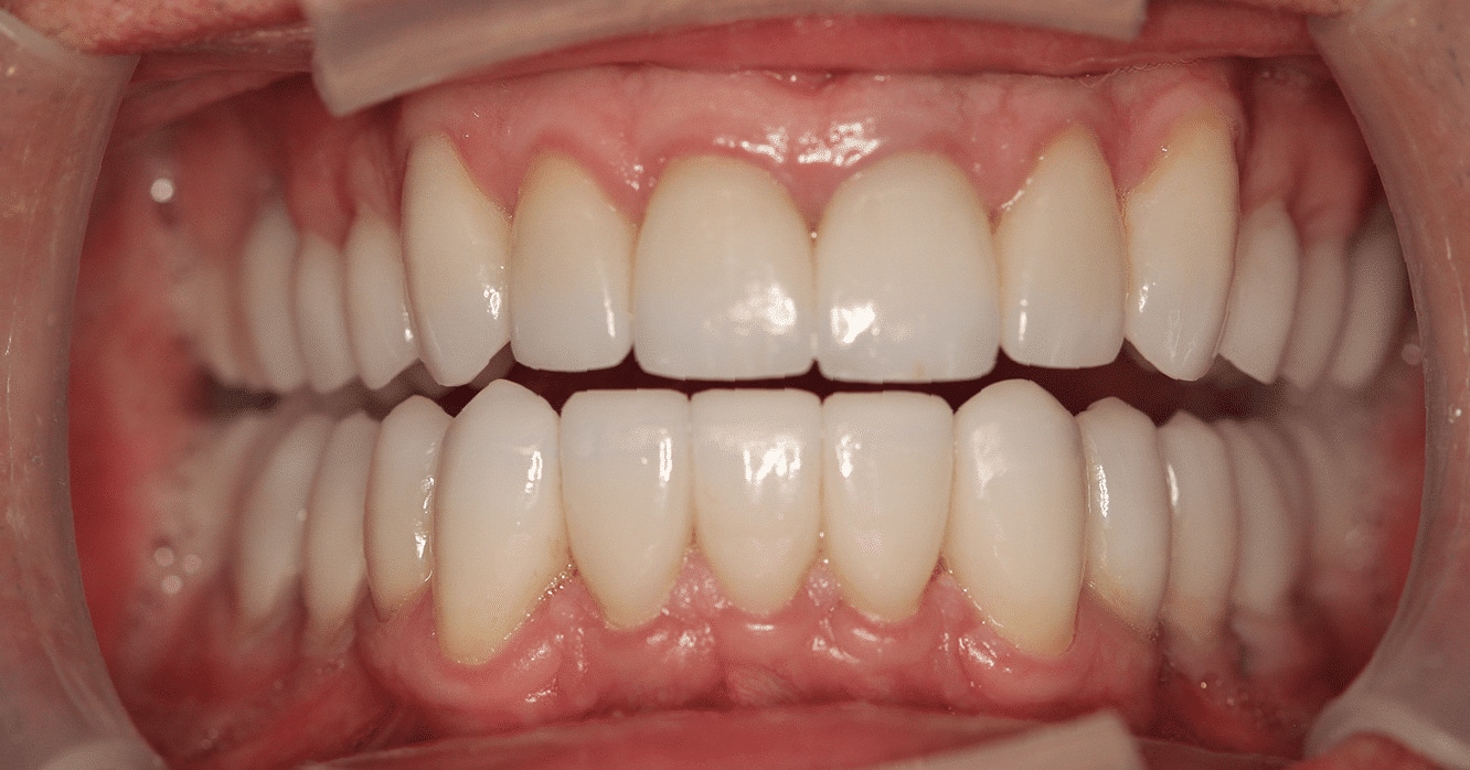 After Treatment