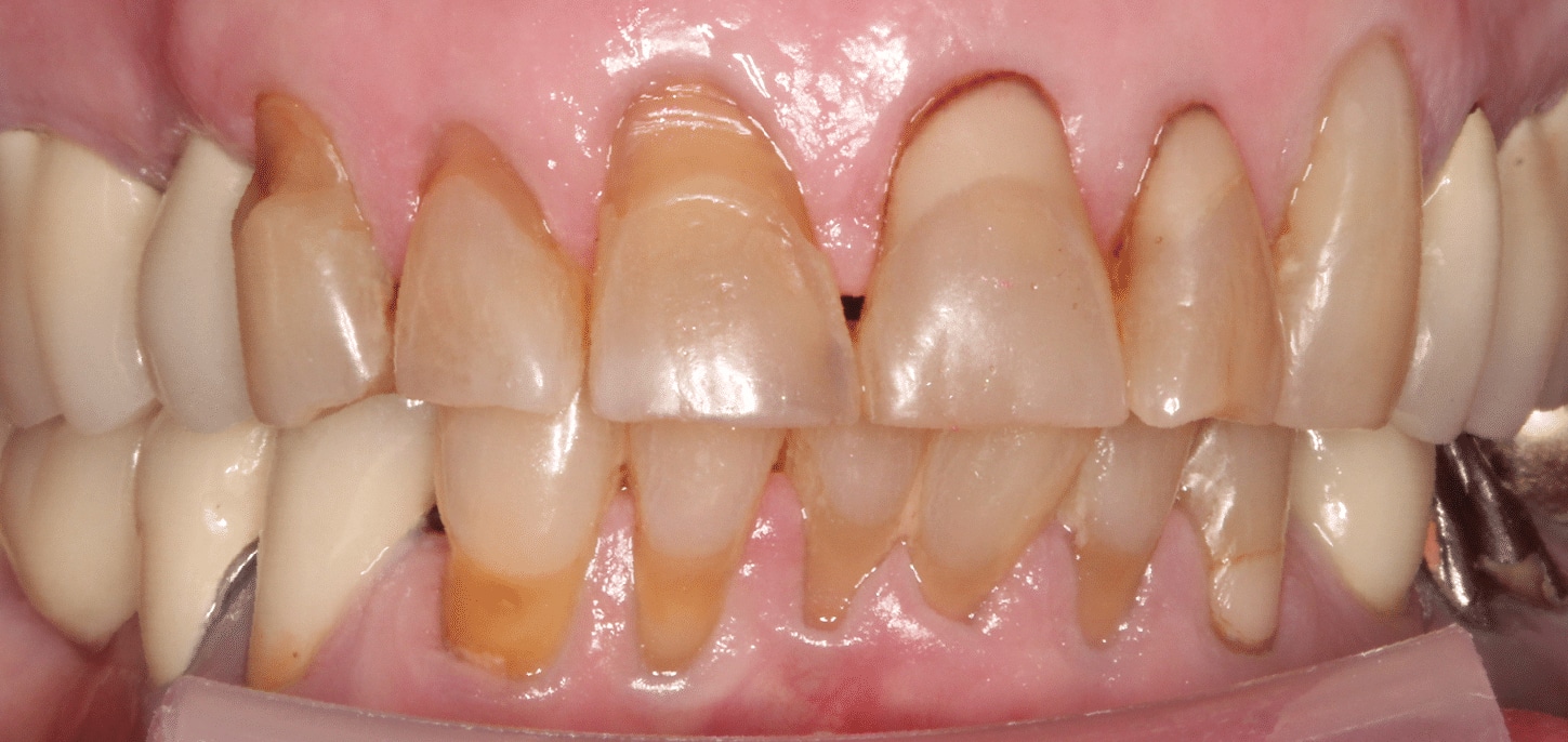 Before Treatment