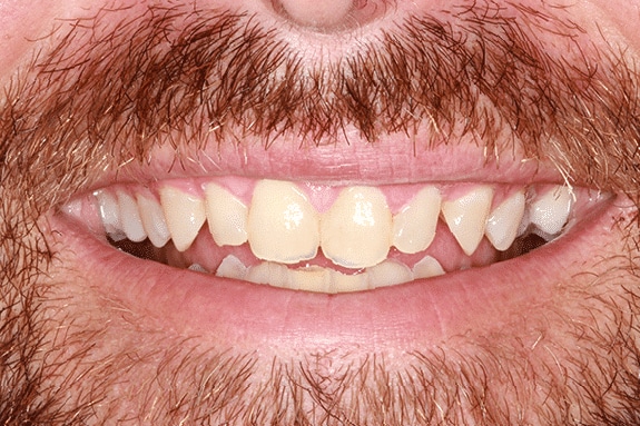 After Treatment