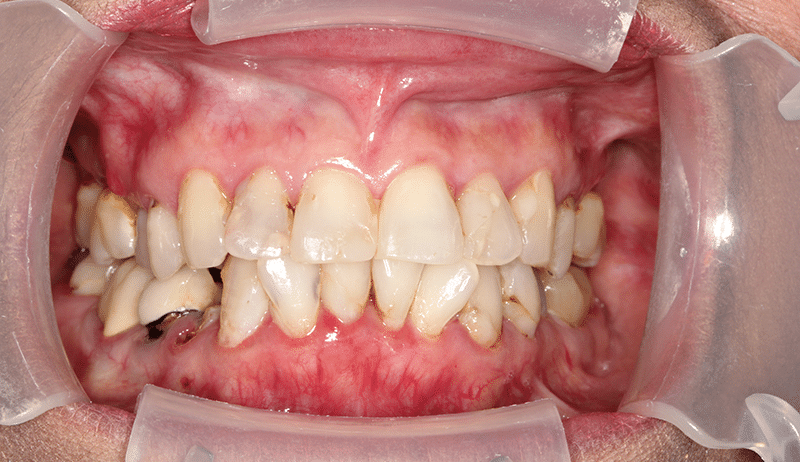 closeup of teeth and gums before teeth in a day procedure