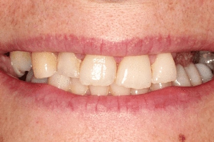 Before Treatment