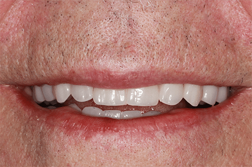 closeup of a man's smile after teeth in a day treatment