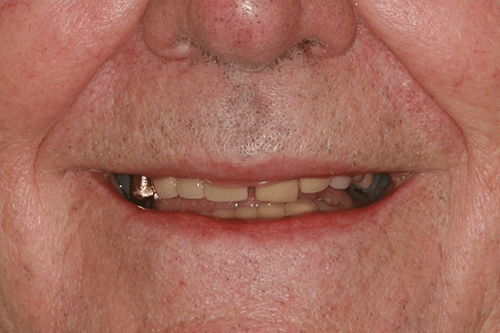 closeup of man before teeth in a day