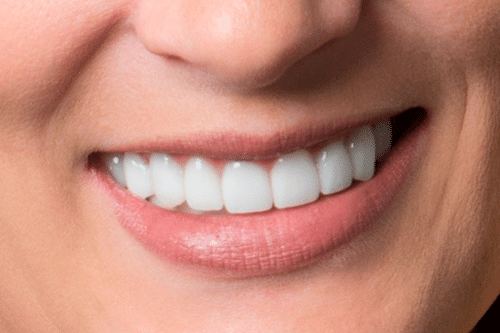 Rikka After cosmetic dentistry after