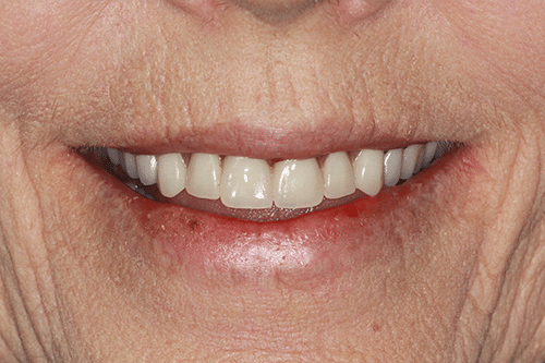 Carol after smile