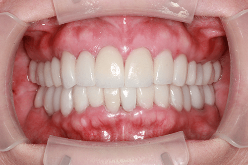 closeup of a smile with teeth and gums after treatment