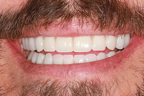 Teeth in a day patient after