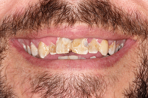 Teeth in a day patient before