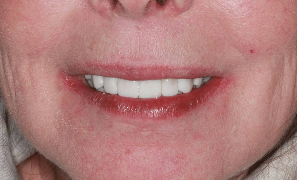 Dental Implant Patient After 1