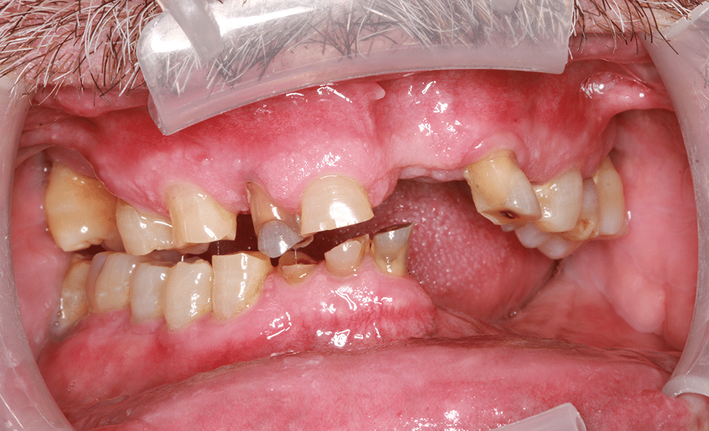 Dental Implant Patient Before