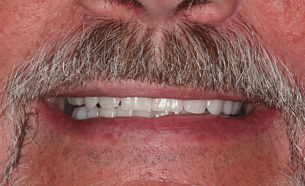 Dental Implant Patient