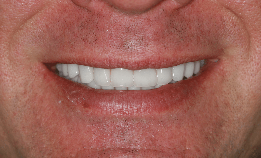 Full Mouth Rejuvenation Patient 3
