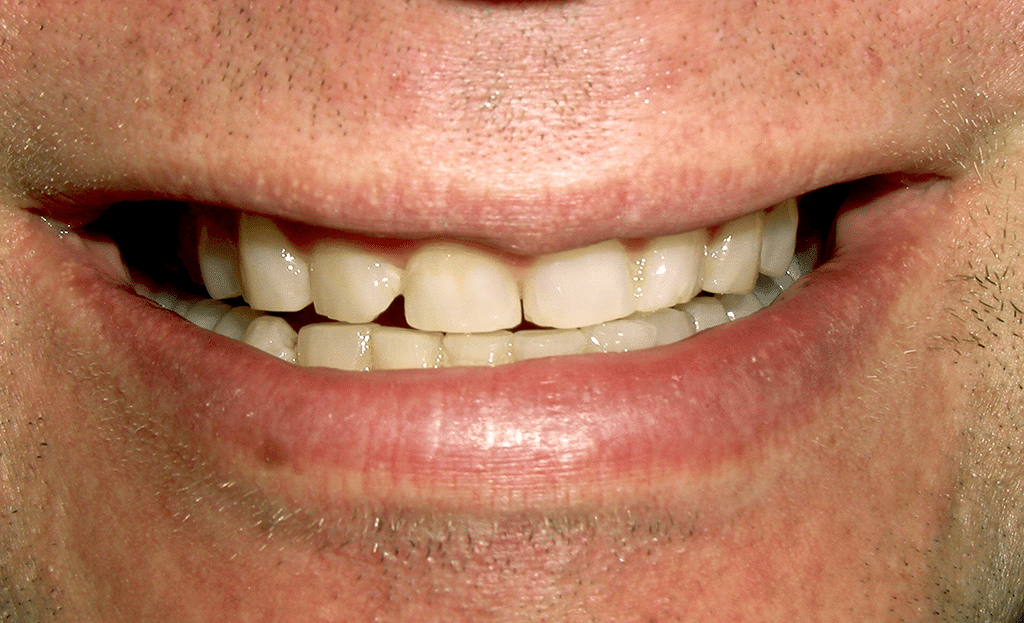 Full Mouth Rejuvenation Patient Before 3