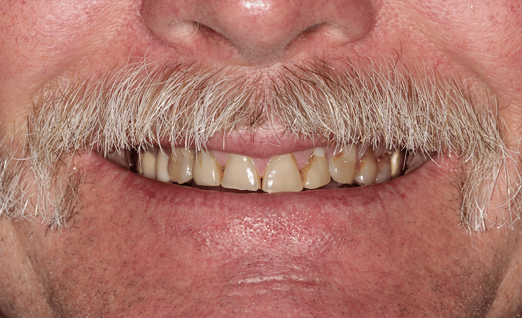 Full Mouth Rejuvenation Patient before 5