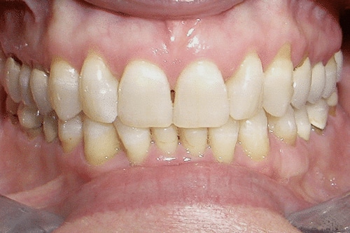 Before Treatment