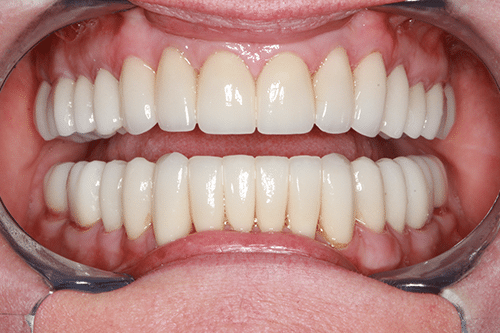 TMJ Patient 10