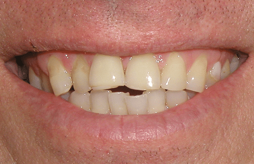 TMJ Patient 11 Before