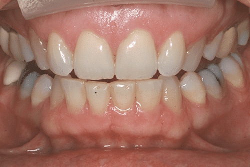 Before Treatment