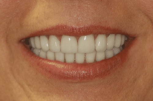 After Treatment