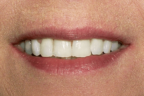 Before Treatment