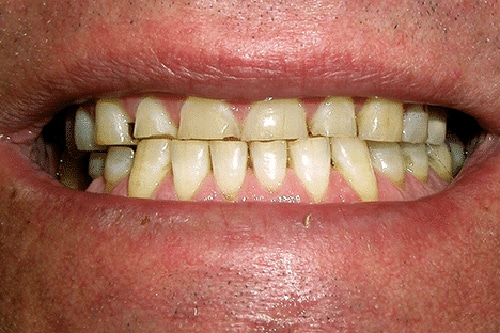 Before Treatment