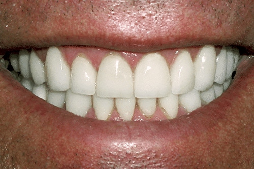After Treatment