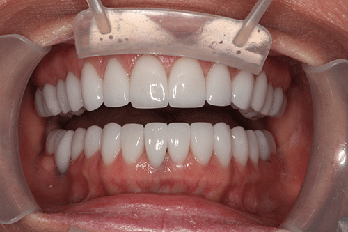 TMJ Patient 3