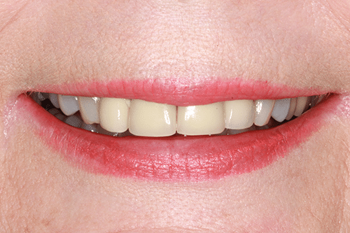 TMJ Patient 5 Before