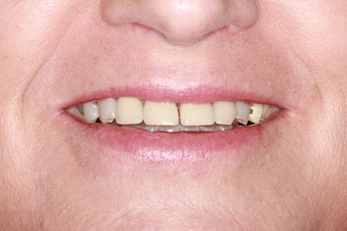TMJ Patient 7 Before