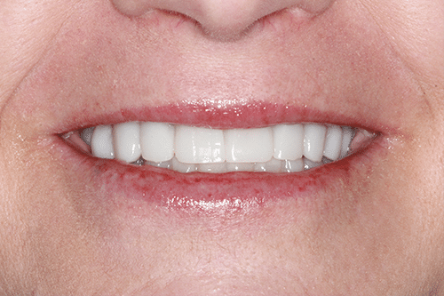 TMJ Patient 7