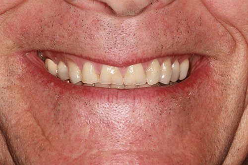 TMJ Patient 8 Before