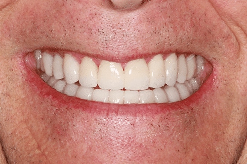 After Treatment
