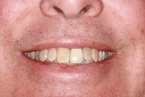 TMJ Patient 9 Before