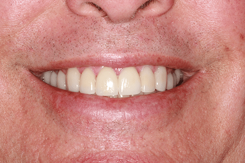 TMJ Patient 9