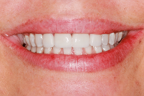 case 1- Porcelain Veneers After
