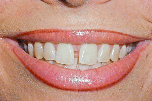 case 1 -Porcelain Veneers Before