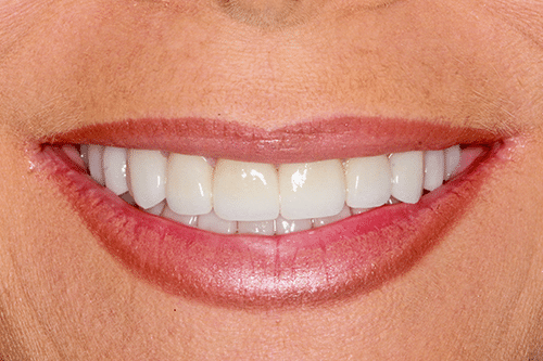 case 2- Porcelain Veneers After