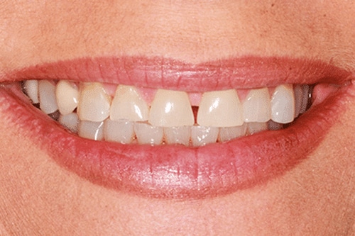 Before treatment